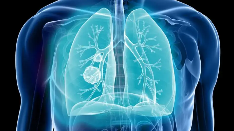Non-Small Cell Lung Cancer